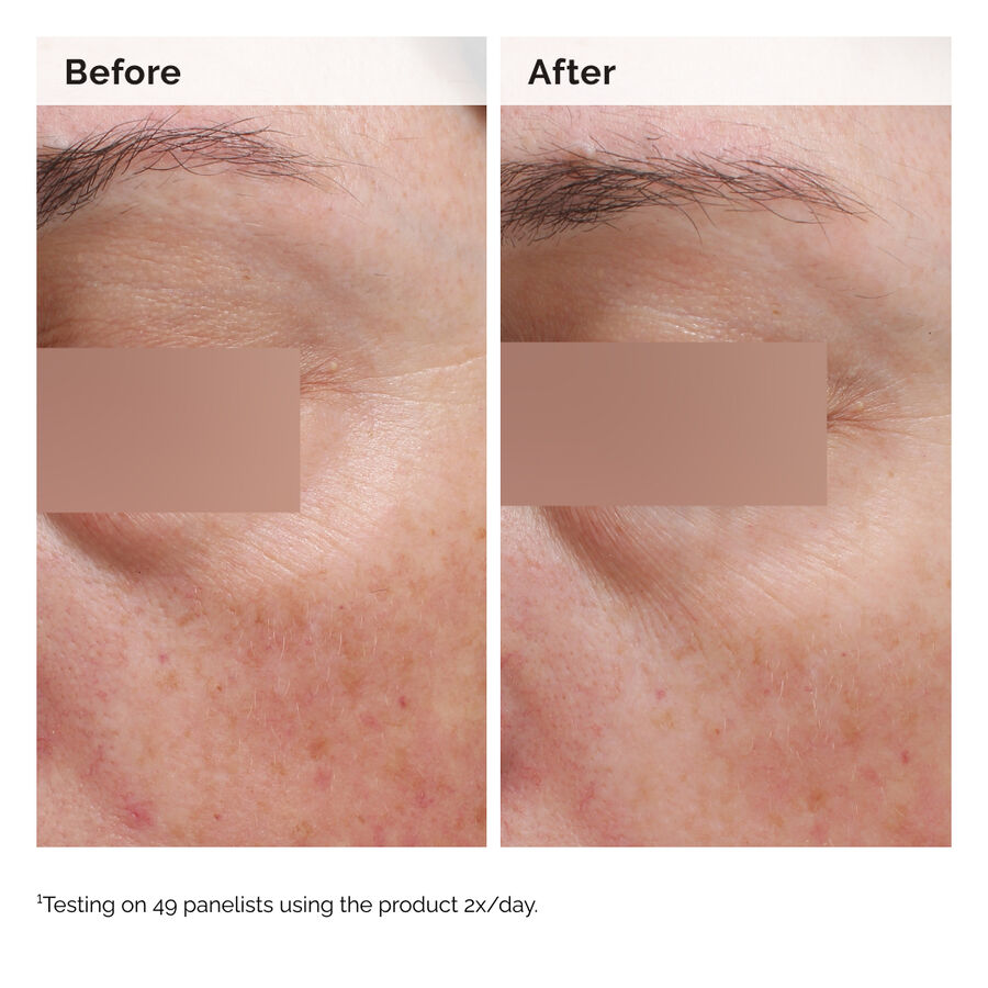 The Ordinary Niacinamide 5% Face and Body Emulsion for dryness | 100ml, morning & evening use