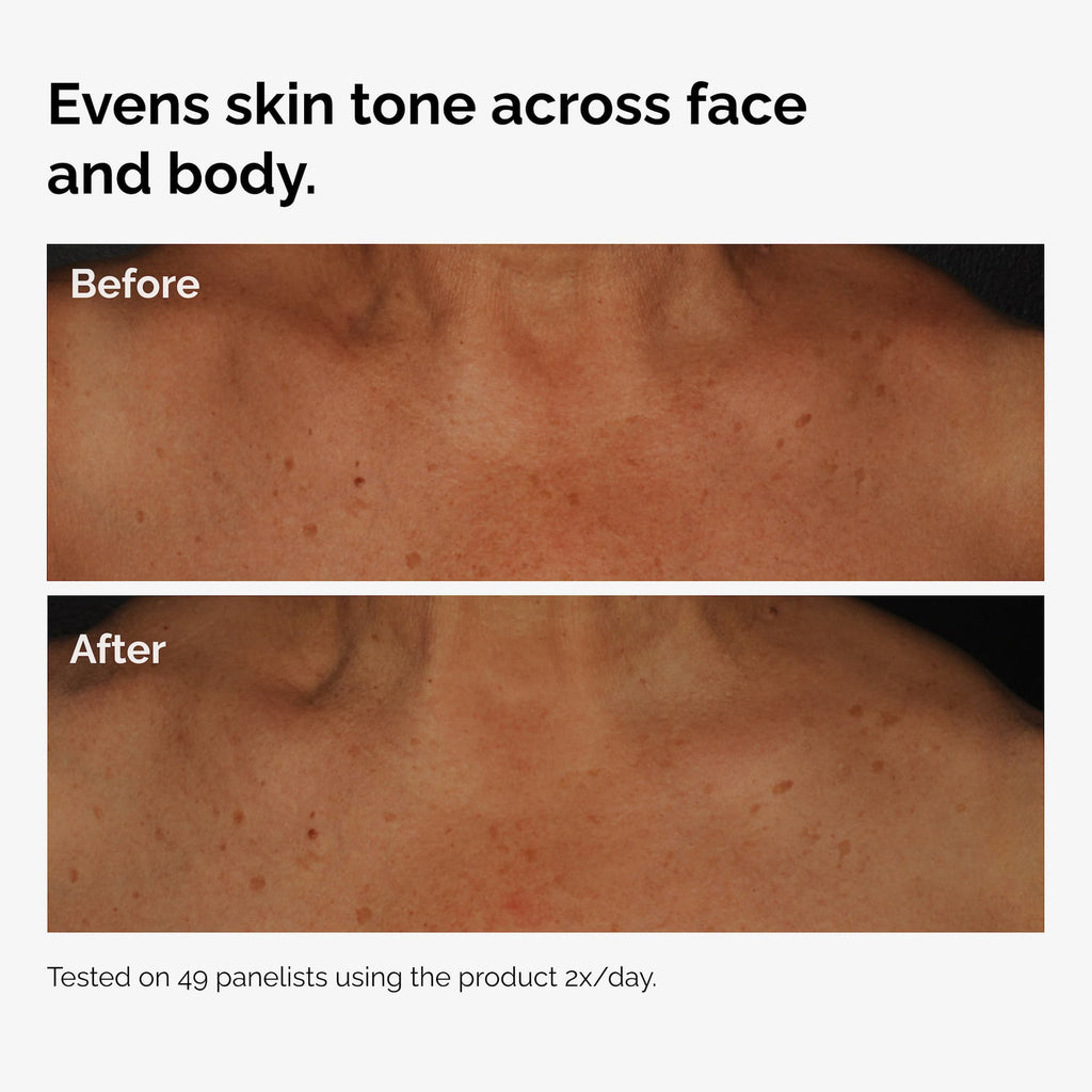 The Ordinary Niacinamide 5% Face and Body Emulsion for dryness | 100ml, morning & evening use