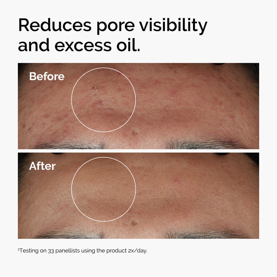 The Ordinary Niacinamide 10% + Zinc 1% Water-Based Serum for textural irregularities | 30ml/60ml, morning & evening use